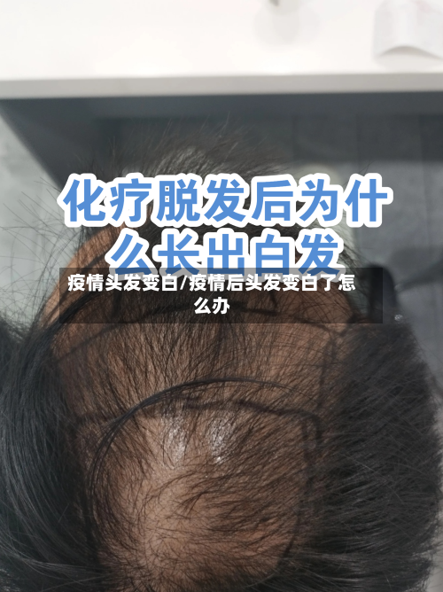疫情头发变白/疫情后头发变白了怎么办-第2张图片