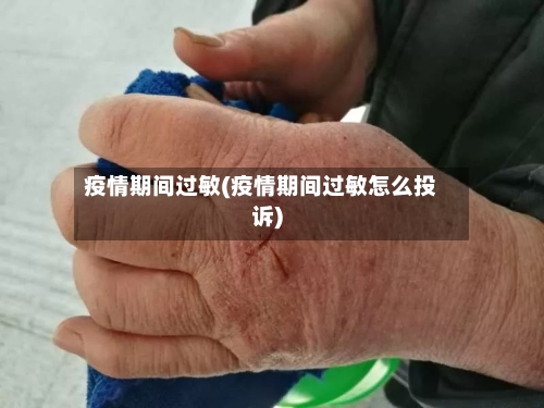 疫情期间过敏(疫情期间过敏怎么投诉)-第3张图片