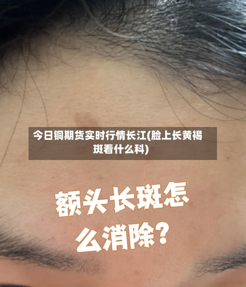 今日铜期货实时行情长江(脸上长黄褐斑看什么科)