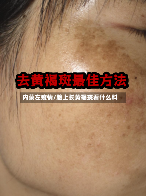 内蒙左疫情/脸上长黄褐斑看什么科-第2张图片
