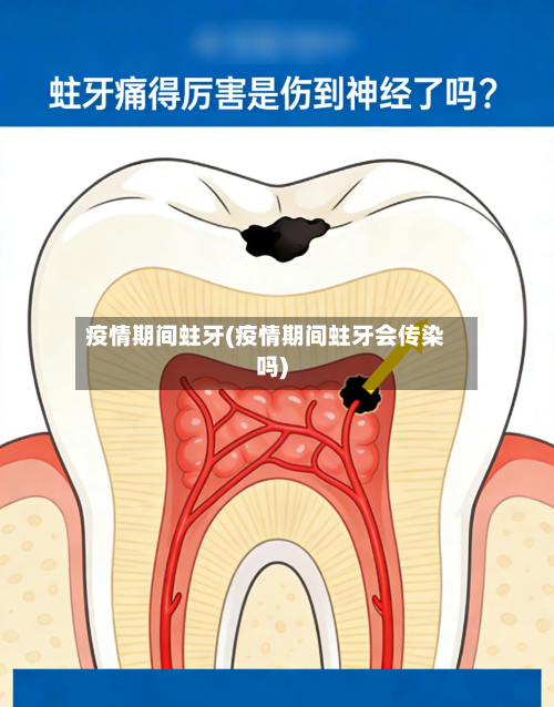 疫情期间蛀牙(疫情期间蛀牙会传染吗)