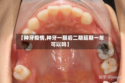 【种牙疫情,种牙一期后二期延期一年可以吗】-第2张图片